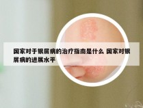 国家对于银屑病的治疗指南是什么 国家对银屑病的进展水平