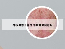 牛皮廨怎么能好 牛皮廨会自愈吗