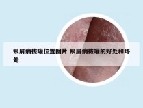 银屑病拔罐位置图片 银屑病拔罐的好处和坏处