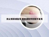 防止银屑病复发 银屑病如何控制不复发