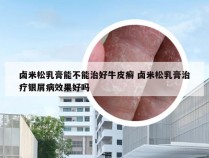卤米松乳膏能不能治好牛皮癣 卤米松乳膏治疗银屑病效果好吗
