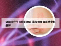 洛阳治疗牛皮癣的地方 洛阳哪里银屑病专科最好