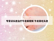 专家谈头孢治疗牛皮癣视频 牛皮屑吃头孢