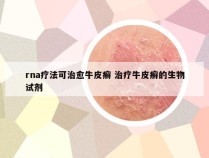 rna疗法可治愈牛皮癣 治疗牛皮癣的生物试剂