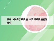 孩子12岁得了银屑病 12岁得银屑病能治好吗