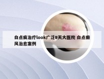 白点疯治疗look广泛#天大医院 白点癫风治愈案例