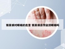 银屑病对眼睛的危害 银屑病会传染到眼睛吗