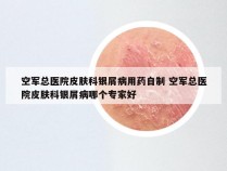空军总医院皮肤科银屑病用药自制 空军总医院皮肤科银屑病哪个专家好