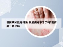 银屑病才能好得快 银屑病好不了了吗?要折磨一辈子吗