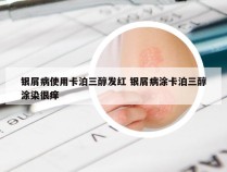 银屑病使用卡泊三醇发红 银屑病涂卡泊三醇涂染很痒