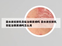 苗水顽皮肤乳膏能治银屑病吗 苗水顽皮肤乳膏能治银屑病吗怎么用