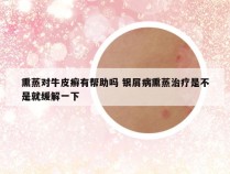 熏蒸对牛皮癣有帮助吗 银屑病熏蒸治疗是不是就缓解一下