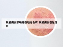 银屑病会影响哪些地方会有 银屑病会引起什么