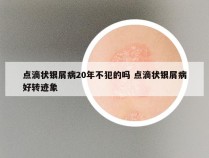 点滴状银屑病20年不犯的吗 点滴状银屑病好转迹象
