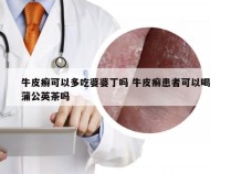 牛皮癣可以多吃婆婆丁吗 牛皮癣患者可以喝蒲公英茶吗