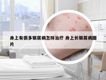 身上有很多银屑病怎样治疗 身上长银屑病图片