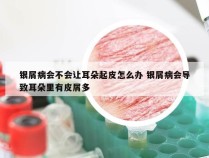 银屑病会不会让耳朵起皮怎么办 银屑病会导致耳朵里有皮屑多