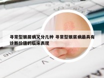寻常型银屑病又分几种 寻常型银屑病最具有诊断价值的临床表现