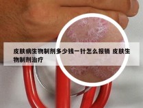 皮肤病生物制剂多少钱一针怎么报销 皮肤生物制剂治疗