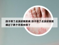 孩子得了点滴状银屑病 孩子得了点滴状银屑病过了两个月我也得了