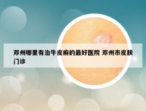 邓州哪里有治牛皮癣的最好医院 邓州市皮肤门诊