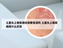 儿童头上银屑病也需要保湿吗 儿童头上银屑病用什么药膏