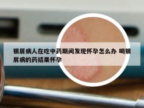 银屑病人在吃中药期间发现怀孕怎么办 喝银屑病的药结果怀孕