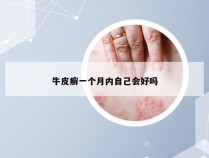 牛皮癣一个月内自己会好吗
