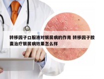 转移因子口服液对银屑病的作用 转移因子胶囊治疗银屑病效果怎么样