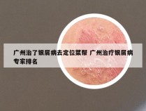 广州治了银屑病去定位菜帮 广州治疗银屑病专家排名