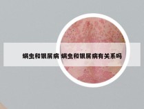 螨虫和银屑病 螨虫和银屑病有关系吗