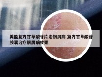 美能复方甘草酸苷片治银屑病 复方甘草酸苷胶囊治疗银屑病效果