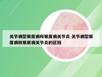 关节病型银屑病和银屑病关节炎 关节病型银屑病和银屑病关节炎的区别