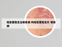 地氯雷他定治银屑病 枸地氯雷他定片 银屑病
