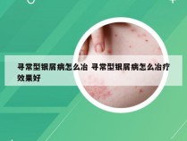寻常型银屑病怎么冶 寻常型银屑病怎么冶疗效果好