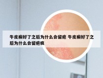 牛皮癣好了之后为什么会留疤 牛皮癣好了之后为什么会留疤痕