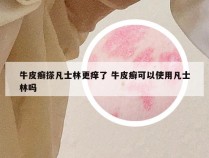 牛皮癣搽凡士林更痒了 牛皮癣可以使用凡士林吗
