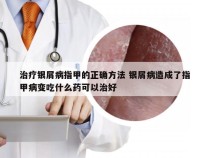 治疗银屑病指甲的正确方法 银屑病造成了指甲病变吃什么药可以治好