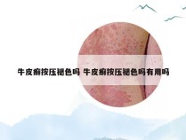 牛皮癣按压褪色吗 牛皮癣按压褪色吗有用吗