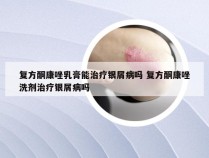 复方酮康唑乳膏能治疗银屑病吗 复方酮康唑洗剂治疗银屑病吗