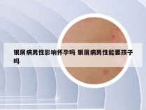 银屑病男性影响怀孕吗 银屑病男性能要孩子吗