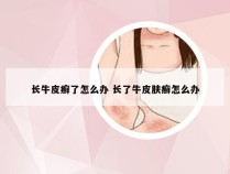 长牛皮癣了怎么办 长了牛皮肤癣怎么办