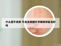 什么是牛皮藓 牛皮皮癣图片早期症状能治好吗