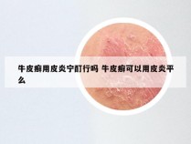 牛皮癣用皮炎宁酊行吗 牛皮癣可以用皮炎平么