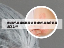 维a酸乳膏缓解银屑病 维a酸乳膏治疗银屑病怎么样