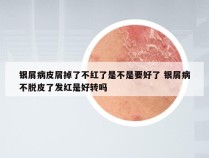 银屑病皮屑掉了不红了是不是要好了 银屑病不脱皮了发红是好转吗