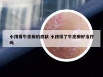 小孩得牛皮癣的症状 小孩得了牛皮癣好治疗吗