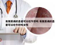有银屑病的患者可以吃牛肝吗 有银屑病的患者可以吃牛肝吗女性