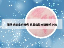 银屑病能吃奶糖吗 银屑病能吃奶糖吗小孩