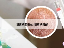 银屑病私密qq 银屑病阴部